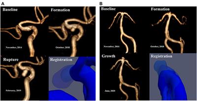 Case Report: Dynamic Changes in Hemodynamics During the Formation and Progression of Intracranial Aneurysms